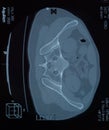 MRI articulation. Study of ankylosing spondyloarthritis patient