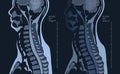 MRI with bilateral C7 root compression, Cervical spondylosis Royalty Free Stock Photo