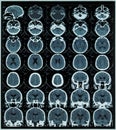 MRI of brain Royalty Free Stock Photo
