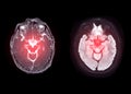 MRI brain axial diffusion image for detect stroke disease .