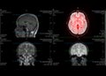 MRI brain axial flair for detect stroke disease .