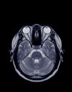 MRI of the brain axial plane for detect a variety of conditions of the brain.