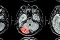 MRI of brain : brain injury Royalty Free Stock Photo