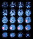 MRI brain : Brain tumor at right parietal lobe Royalty Free Stock Photo