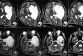 MRI of the brain, brain tumor - MR Royalty Free Stock Photo