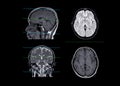 MRI brain compare axial, coronal and sagittal plane