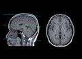 MRI brain compare axial and sagittal plane