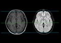 MRI brain compare axial T1W and T2W Flair