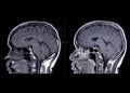 MRI brain compare sagittal t1w non gadolium and with gadolinium