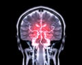 MRI brain Coronal T2W and MRA Brain fusion in Coronal view