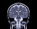 MRI Brain Coronal t2W view for detect a variety of conditions of the brain such as cysts, tumors, bleeding isolated on the