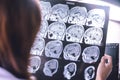 MRI brain Dementia