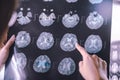 MRI brain Dementia
