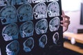 MRI brain Dementia