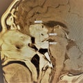 Mri brain exam pituitary pathology