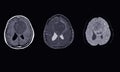 MRI BRAIN Finding of meningioma arising from anterior falx cerebri, extending to bilateral frontal regions, with adjacent minimal