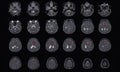 MRI BRAIN Finding of meningioma arising from anterior falx cerebri, extending to bilateral frontal regions, with adjacent minimal