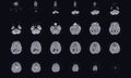 MRI BRAIN Finding of meningioma arising from anterior falx cerebri, extending to bilateral frontal regions, with adjacent minimal