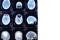 MRI of the brain . Human health. X-ray image. MRI scan or magnetic resonance image of head and brain scan Royalty Free Stock Photo