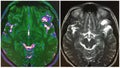 Mri brain inferior frontal dnet structure collage
