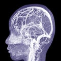 MRI THE BRAIN.Moderate perilesional vasogenic edema with 0.7 cm midline shift to the left side.Medical image concept