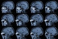 MRI OF BRAIN AND ORBIT Finding A well-defined, cystic lesion with internal papillary projection at the medial aspect, occupying at