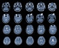 MRI OF BRAIN AND ORBIT Finding A well-defined, cystic lesion with internal papillary projection at the medial aspect, occupying at