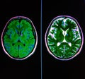 Mri brain periventricular lesion low grade neoplazm