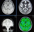 Mri brain periventricular lesion low grade neoplazm