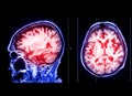 MRI brain sagittal and Axial T2 flair technique