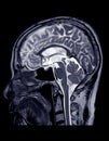 MRI of the brain sagittal plane. Royalty Free Stock Photo