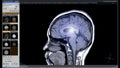MRI of the brain Sagittal T1