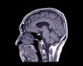 MRI of the brain sagittal T1 view Royalty Free Stock Photo