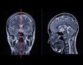 MRI brain scan Compare Coronal and sagittal plane for detect Brain diseases sush as stroke disease, Brain tumors and