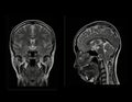 MRI brain scan Compare Coronal and sagittal plane for detect Brain diseases sush as stroke disease, Brain tumors and