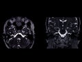MRI Brain scan  with  the internal auditory canal (IAC) axial  and Coronal view Royalty Free Stock Photo