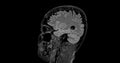 MRI brain scan sagittal flair for detect Brain diseases sush as stroke disease, Brain tumors and Infections