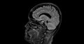 MRI brain scan sagittal flair for detect Brain diseases sush as stroke disease, Brain tumors and Infections