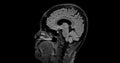 MRI brain scan sagittal flair for detect Brain diseases sush as stroke disease, Brain tumors and Infections