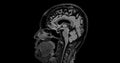 MRI brain scan sagittal flair for detect Brain diseases sush as stroke disease, Brain tumors and Infections