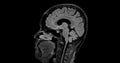 MRI brain scan sagittal flair for detect Brain diseases sush as stroke disease, Brain tumors and Infections