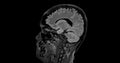 MRI brain scan sagittal flair for detect Brain diseases sush as stroke disease, Brain tumors and Infections