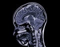 MRI brain scan sagittal plane for detect Brain diseases sush as stroke disease, Brain tumors and Infections