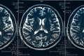 MRI brain scan or x-ray neurology human head skull tomography test