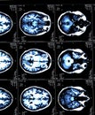 MRI brain scans of a patient with Multiple Sclerosis