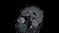 MRI brain scans sagittal view offer valuable insights into brain