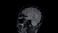 MRI brain scans sagittal view offer valuable insights into brain