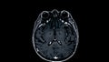 MRI brain scans sagittal view offer valuable insights into brain