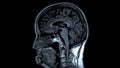 MRI brain scans sagittal view offer valuable insights into brain