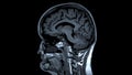 MRI brain scans sagittal view offer valuable insights into brain